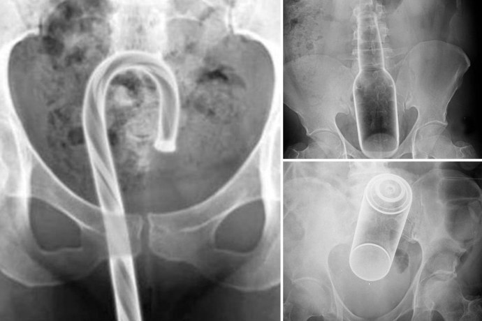 Инородные предметы в прямой кишке