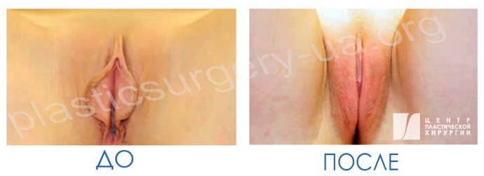 Сигмовидная вагинопластика