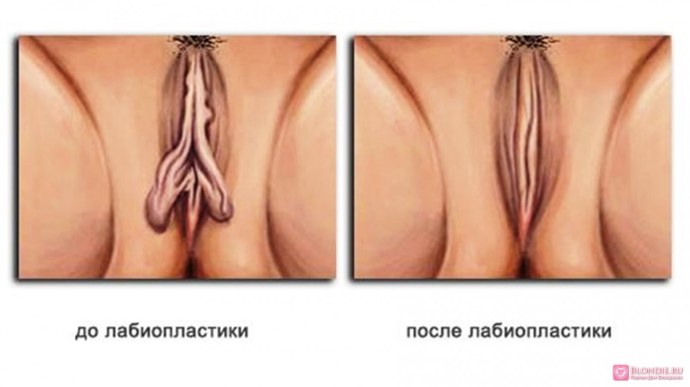 Белые штуки в пипиське