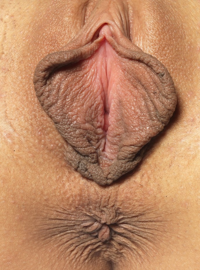 Огромные висячие половые губы