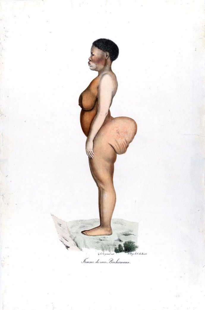 Выпадение женских половых органов