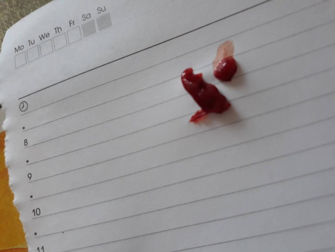 Выкидыш на раннем сроке плодное яйцо