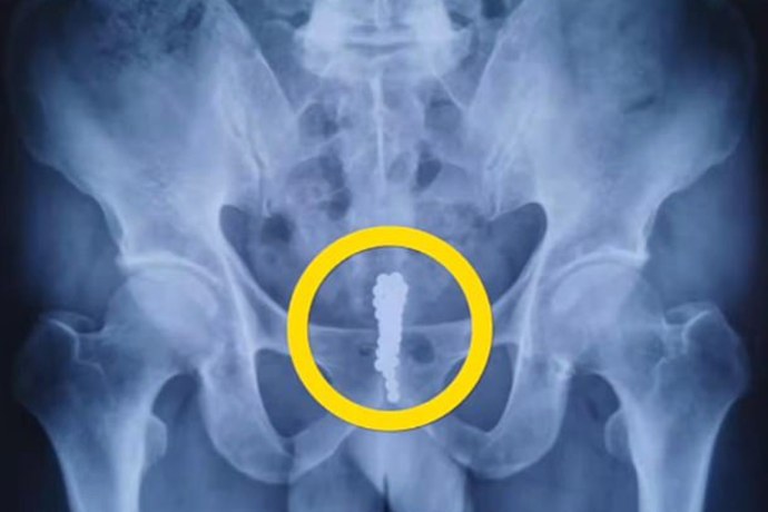 Мужской половой орган с шариками