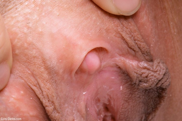 Новообразования вульвы