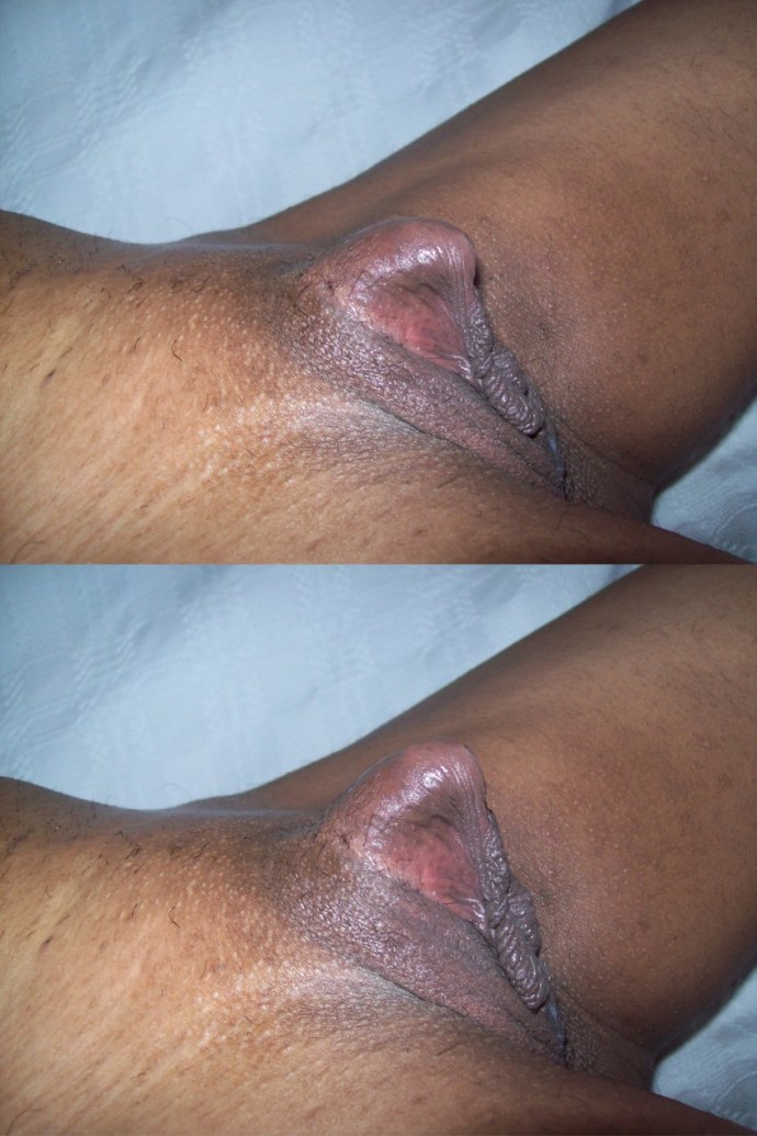 Вагина без половых губ