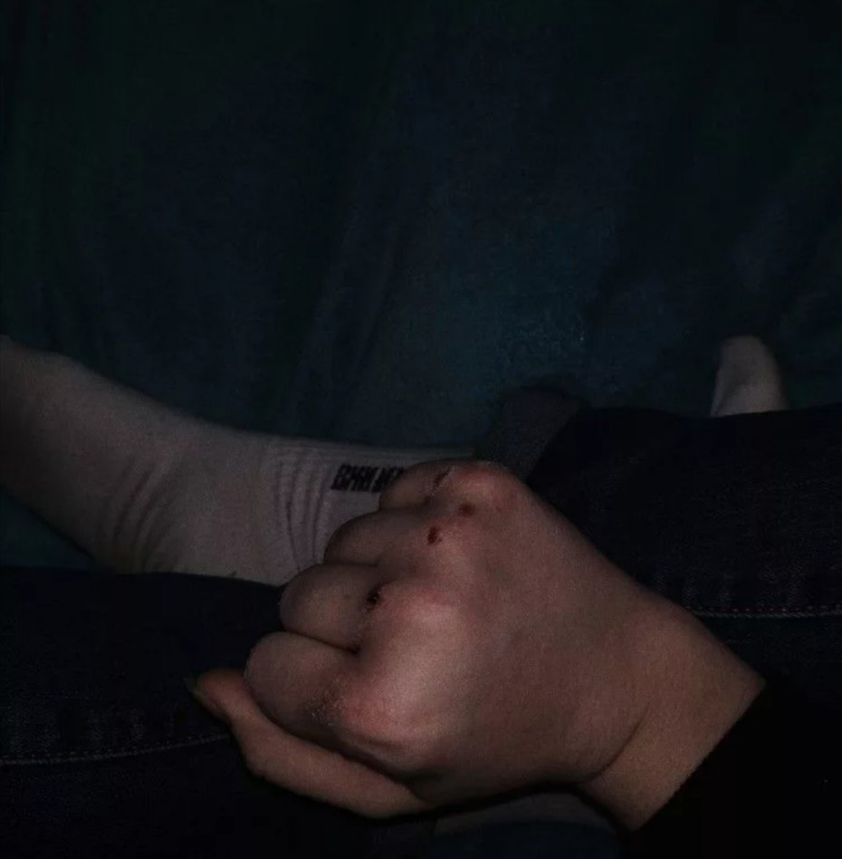 Ушиб пальца ноги рентген