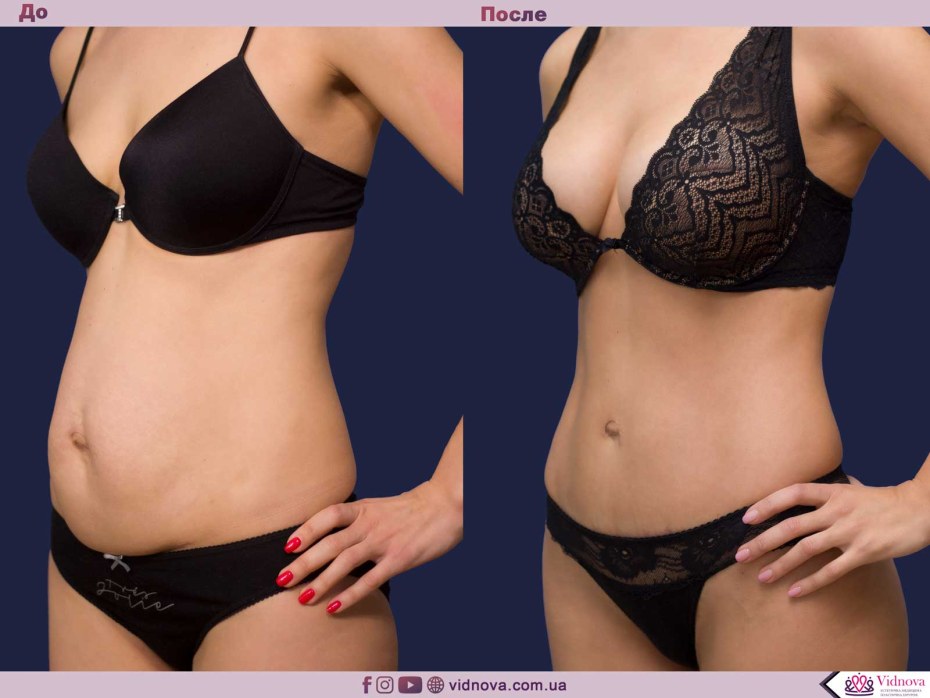 Гузеева блефаропластика до и после