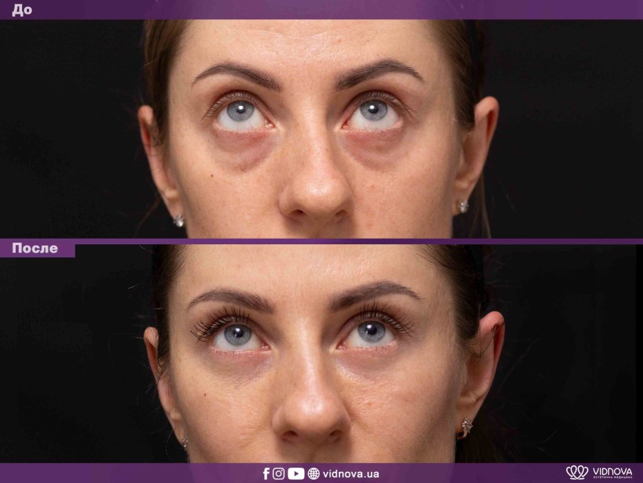 Липомоделирование галифе