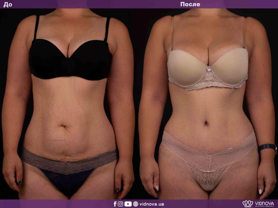 Анатомические импланты фото голая грудь