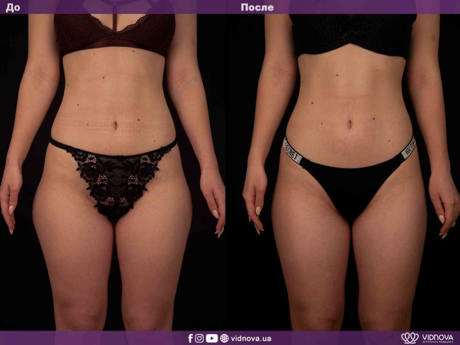 Лазерное омоложение фотона 4д