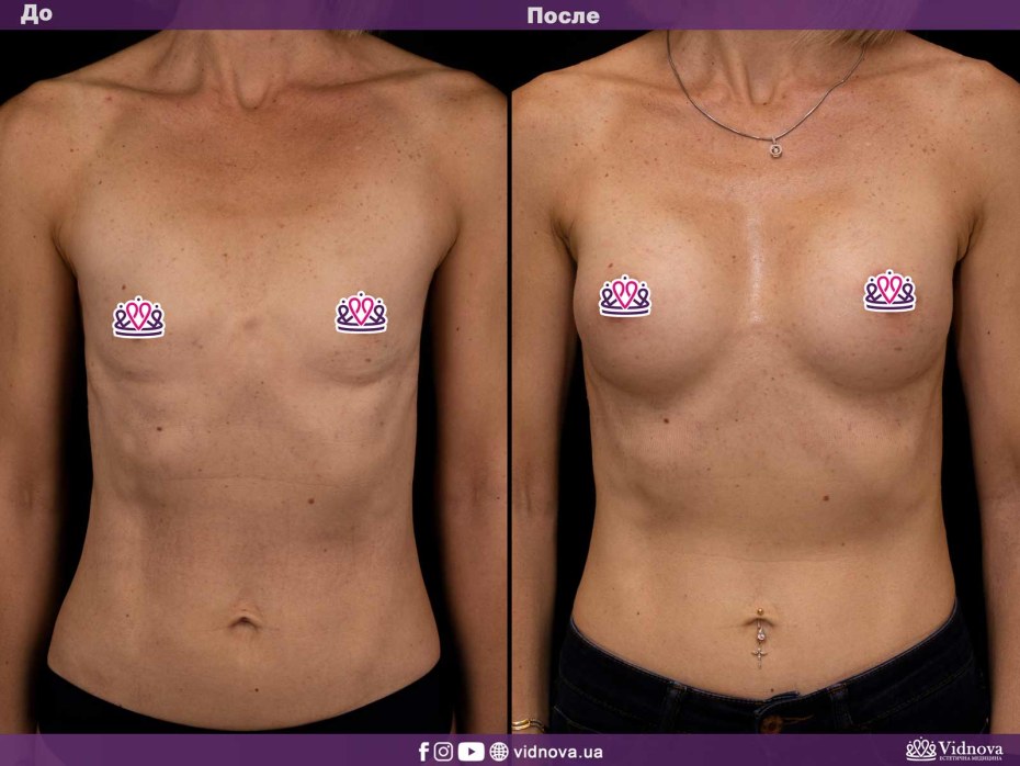 Катя Усманова блефаропластика до и после фото