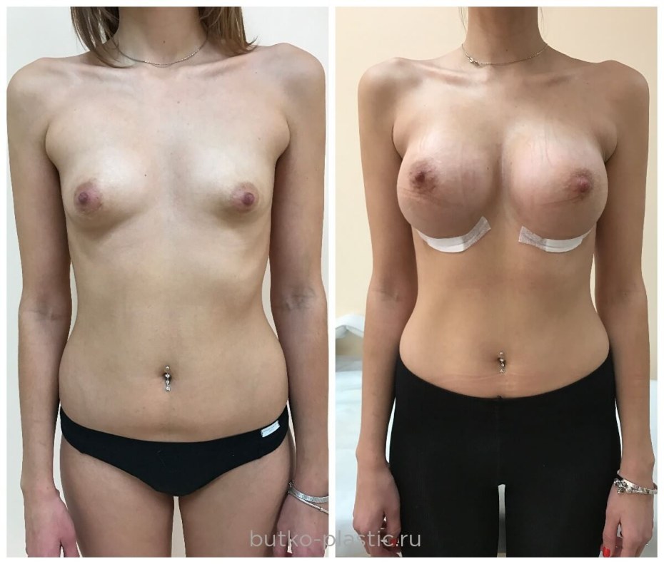 Увеличенная грудь